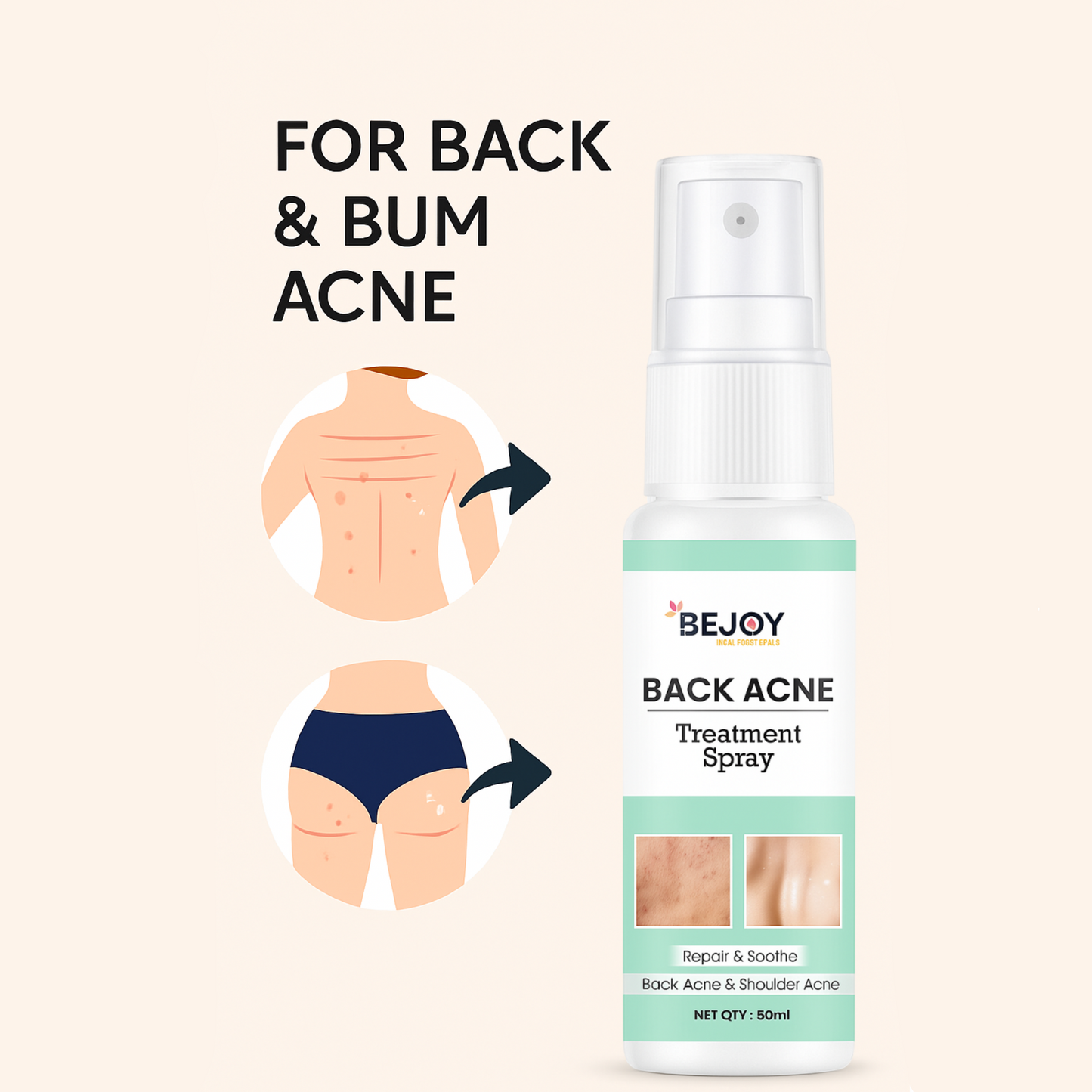 Back and Bum Acne Treatment Spray (Pack of 2)