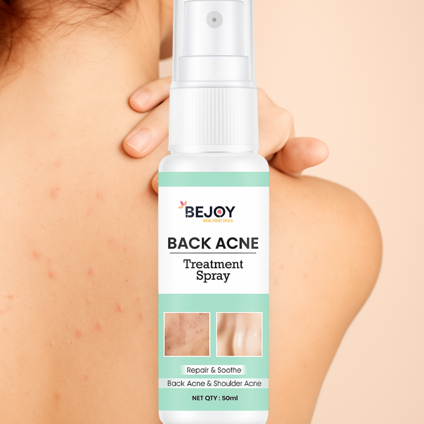 Back and Bum Acne Treatment Spray (Pack of 2)