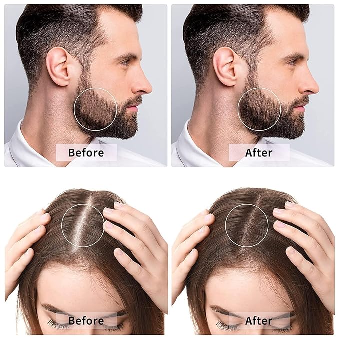 Derma Roller 0.5mm for Hair & Beard Growth – 540 Titanium Micro Needles